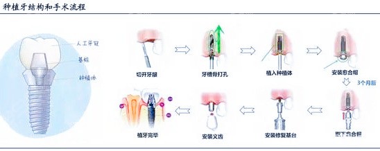 最新种牙技术